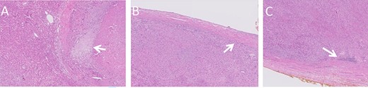 Histologic images of the resected lesion including IVC segment. (A) H&E staining, X20 magnification, demonstrating cells showing cytological atypia with areas of necrosis (arrow). (B + C) H&E staining, X20 magnifications, showing the tumour adjacent and originating from the IVC.