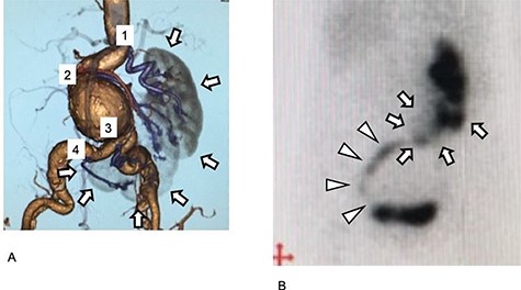 Preoperative images of the aneurysm and the kidney. (A) Preoperative three-dimensional enhanced CT image. Four RA are visible (purple and numbered). Cross-fused renal ectopia was diagnosed, and the right kidney had migrated to the left side. The kidney is L-shaped and indicated in gray (arrow). (B) Preoperative 99mTc-MAG3 renogram. The L-shaped kidney is well observed (arrow). The urinary tract arises from the left side of the kidney and progresses to the right side, and then finally runs into the bladder at the right side (arrowhead).