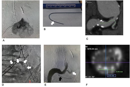 Images associated with chimney graft technique procedures. (A) Selective arteriogram of the third renal artery. The area perfused by the artery is large. (B) Before insertion, a stiff wire was shaped according to the preoperative CT image analysis. The tip of the stiff portion is indicated by a white arrow. The portion distal to the white arrow is more pliable, preventing damage to the third renal artery and the kidney. (C) Preoperative CT. The estimated access route for the chimney graft and the stiff wire is indicated by a green line. (D) The stiff wire is placed into the third renal artery. (E) Arteriogram after completing all procedures. The third renal artery is perfused via the covered stent (white). The fourth renal artery is preserved (black). No gutter-related type II endoleak occurred. (F) Postoperative CT. The cross-section of the chimney graft is 2.4 × 8.4 mm.