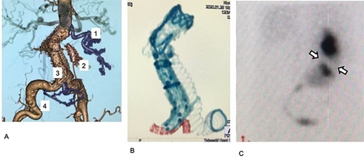 Postoperative images. (A) Postoperative enhanced CT. The first, third, and fourth RA are preserved (purple). The third renal artery is preserved by a chimney graft with good perfusion. (B) Stent grafts and the covered stent on postoperative plane CT. The covered stent is shown in red. The stent tracks well to the acute angle of the third renal artery. (C) Postoperative 99mTc-MAG3 renogram. Collection ceased in a small region in the kidney, which was assumed to be perfused by the second renal artery (arrow).