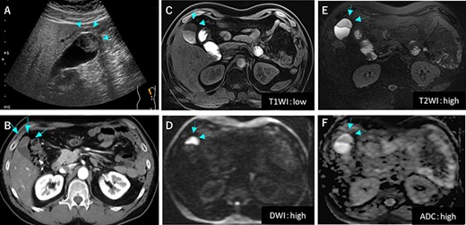 Preoperative image findings; (A) Gallbladder tumor was at gallbladder body by abdominal ultrasonography; (B) CT scan revealed slightly enhanced tumor located at gallbladder fundus; (C–F) On MRI, the tumor had high signal in both of T2 and diffusion weighed image and low signal in both of T1 and apparent diffusion coefficient.