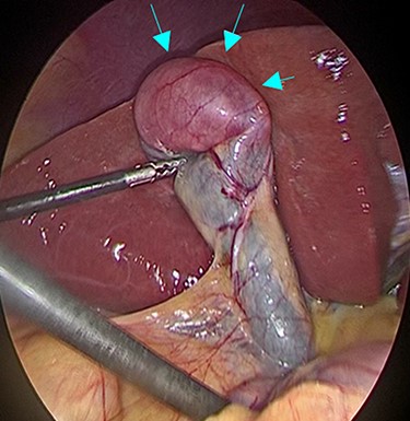 Intraoperative findings during laparoscopic cholecystectomy; The tumor was at fundus of gallbladder without serosal invasion.