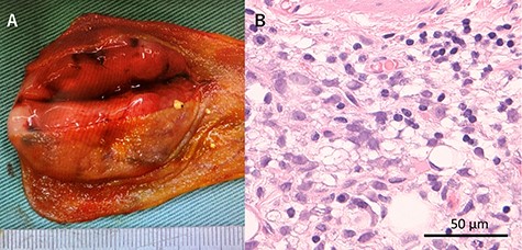 Macroscopic and microscopic findings of the resected specimen; (A) Tumor was solid and well-defined tumor mainly in the submucosa; (B) Tumor was myxoid liposarcoma consisting of solid growth of lipoblasts and round cells; There was no necrosis and proliferation of spindle and round cell component were identified in the background of myxoid stroma.