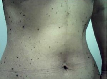 Preoperative seborrheic keratoses.