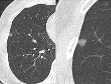 Computed tomography (CT) shows a ground-glass nodule in the right lower lobe.