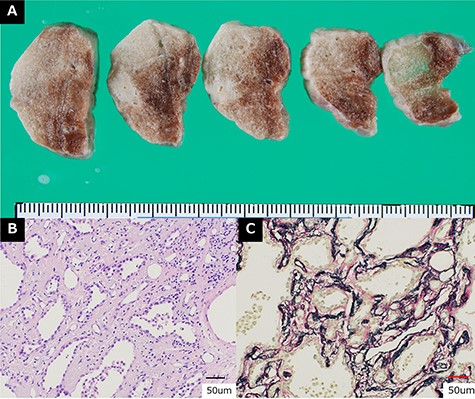 Pathological findings. (A) Macroscopic specimen of the resected tumors. (B) Hematoxylin and eosin staining (×200). (C) Elastica van Gieson staining (×200). These findings were compatible with typical adenocarcinoma in situ, Noguchi type B.