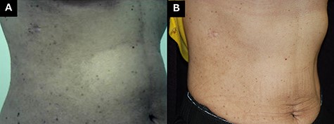 Seborrheic keratoses after resection of the lung nodule. (A) Two years after the operation. (B) Four years after the operation.
