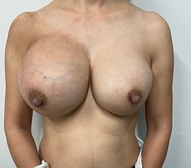 Significant breast asymmetry with right breast being larger and more erythematous than the left breast with accentuation of the superficial veins.