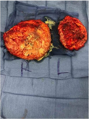 Gross pathological specimen demonstrating extensive fibrotic capsules and porridge-like consistency of PAAG.