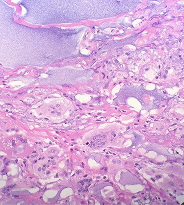 Microscopic examination reveals benign breast tissue with fibrosis, foreign body giant cells and chronic inflammatory cells (H&E 20×) Extensive, scattered, purple, gelatin-like material was also present which represents the presence of polyacrylamide hydrogel.