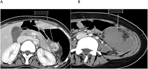 Cross-sectional images of the same patient at the time of infarction. A. Twisted pedicle. B. Infarcted WS.