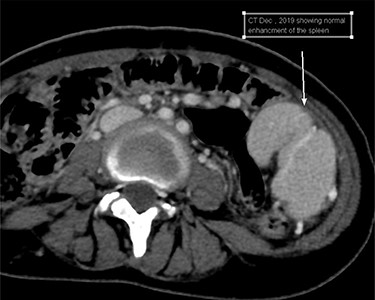 Cross-sectional image at the time initial diagnosis shows normal enhancement.