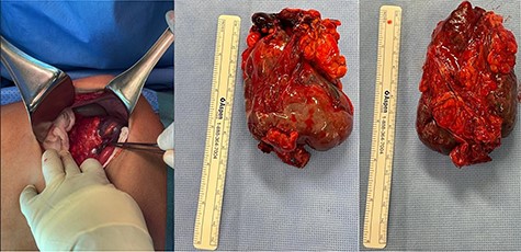 Intraoperative clinical photographs showing infarcted malformed WS.