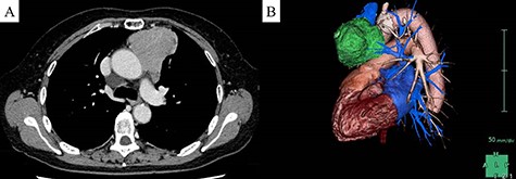 Preoperative image of the tumor. (A) Chest computed tomography revealed a 62-mm anterior mediastinal tumor. (B) Left lateral three-dimensional view of the tumor (green) indicated that the tumor appeared to invade the left phrenic nerve.