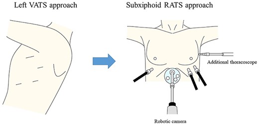 Surgical approach. RATS, robotic-assisted thoracic surgery.
