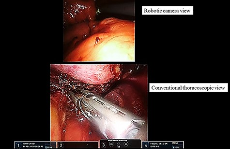 Dual-scopic approach. With the aid of a dual-scopic approach using both a robotic camera and conventional thoracoscopic images, minimally invasive surgical resection of a challenging thymic tumor was achieved.