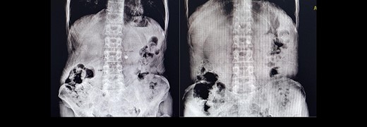 Supine and upright abdominal X-ray.