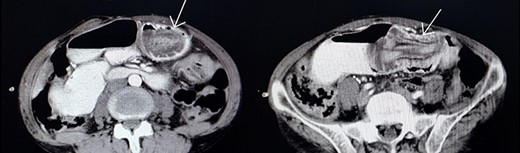 Jejunogastric intussusception showed (arrow) in abdominopelvic CT scan with Iv/oral contrast.
