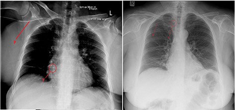 Chest X-ray after (left) PICC insertion and after withdrawal (right). P—PICC line tubing traced to the tip (T) in the right atrium (left) and superior vena cava (right).