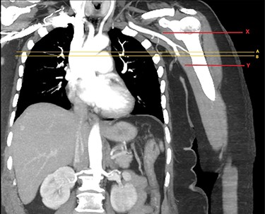 CTA of left upper limb in the coronal plane. X—axillary artery with contrast showing flow as evident in transverse imaging (see Fig. 3), patent in the transverse plane marked A. Flow ceases approximately at the level of the plane marked B. Y—axillary artery occluded as shown with contrast absent.