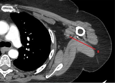CTA of left upper limb in the transverse plane. B—axillary artery without contrast showing occlusion due to embolism as evident in transverse imaging at B-line (see Fig. 2).