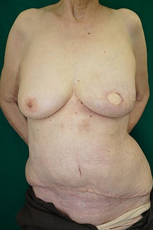 Three months after surgery.