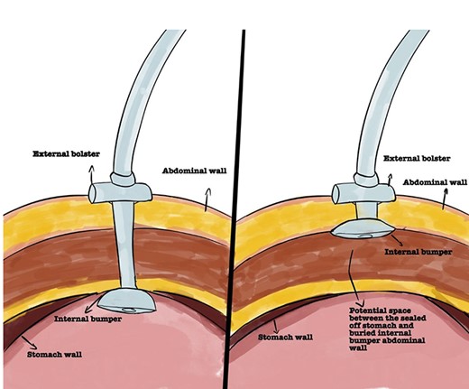 Representation of normal PEG positioning (right) and BBS (left).