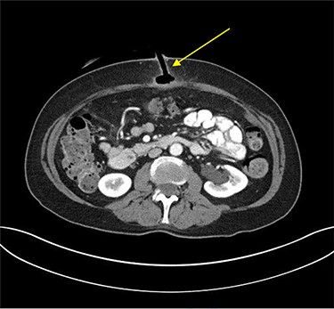 Transverse plane of CT of abdomen and pelvis illustrating the migration of the internal bumper of the PEG and the sealing of gastric mucosa as indicated by the yellow arrow.