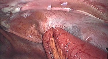 Small bowel herniation via peritoneal defect post TAPP.