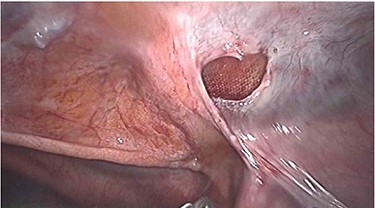 Peritoneal defect post-reduction of herniated small bowel with visible mesh.