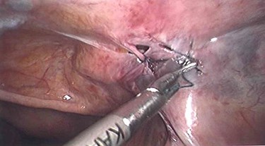 Laparoscopic suture closure of peritoneal defect.