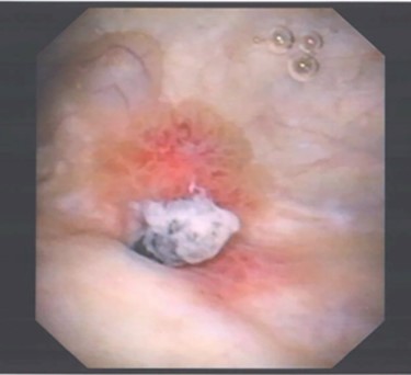 Image of suspected ‘tumour’ on right posterolateral wall of the bladder, taken during flexible cystoscopy.