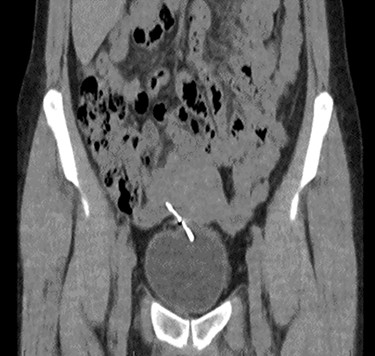 Coronal CT urinary tract image demonstrating the device lying between uterus and bladder, with one horn of the device embedded into the bladder.