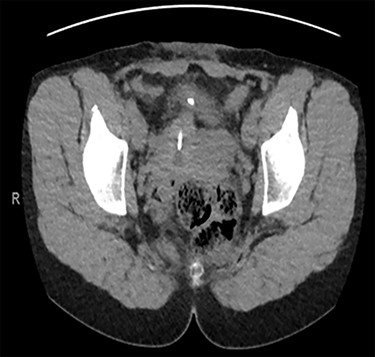 Axial CT urinary tract image demonstrating the device lying between uterus and bladder.