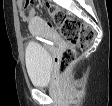 Sagittal CT urinary tract image demonstrating the device lying between uterus and bladder.