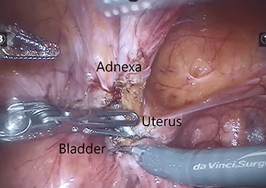Intraoperative image demonstrating the IUCD (white) located between the bladder and uterus.