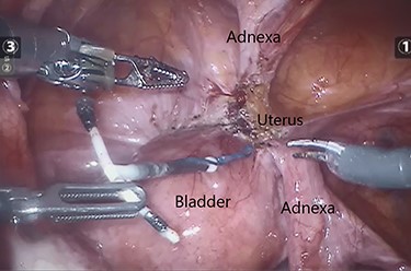 Intraoperative image demonstrating the dissected and released IUCD.