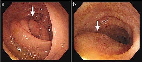 Colonoscopy findings colonoscopy reveals swelling of the Bauhin valve (a) and an elevated tumor of the terminal ileum (b).