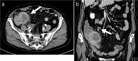 CT findings (a: axial image in the artery phase; b: coronal image in the artery phase). Abdominal contrast-enhanced CT showing a partially high-density tumor (diameter: 90 × 70 mm) at the cecum and some peripheral lymphadenopathy (shown by arrow).