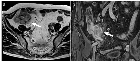 MRI findings (a: T2-weighted axial image; b: contrast enhanced T1-weighed coronal image). MRI showing a tumor (diameter: 60 × 40 mm) with thickening of the appendix wall near the cecum (arrow).