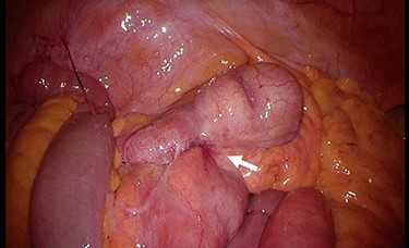 Intra-operative findings. Inflammation is observed at the terminal ileum (arrow).