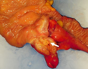 The resected specimen. The resected specimen showing a yellowish change near the appendix root (arrow).