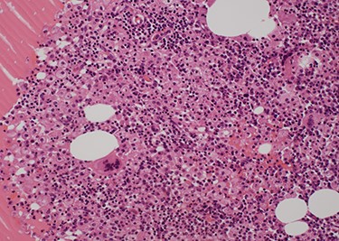 Pathological findings (Hematoxylin–Eosin staining×20). A nodular lesion with unclear boundaries is formed by fibrous cells, foamy histiocytes, foreign-body giant cells and inflammatory cell infiltration.