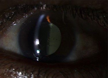Pre-operative slit lamp photo showed turbid fluid behind the IOL, and the IOL pitting indicates a previous trial of YAG capsulotomy.