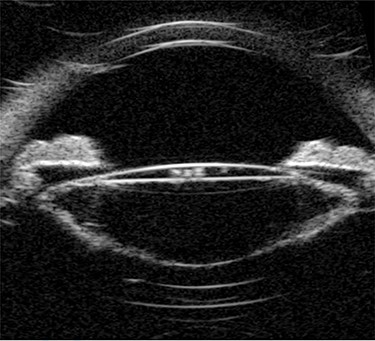 Pre-operative UBM shows a markedly distended capsular bag and thickened posterior capsule.
