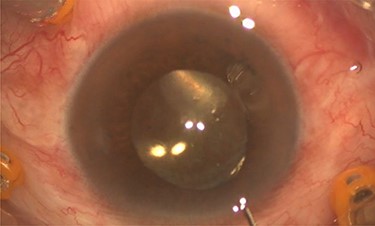 Intra-operative photo showed egression of turbid fluid to the anterior chamber.