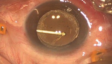 Intra-operative photo showed the posterior capsulotomy using 23G vitrector.