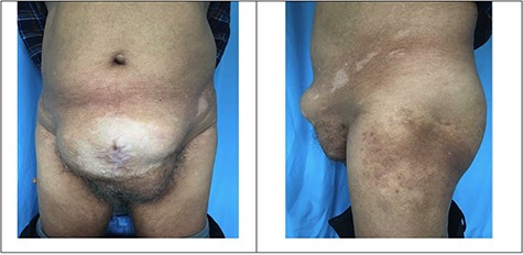 Protuberant lower midline incisional hernia before surgery.