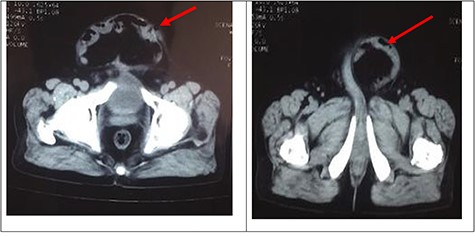 CT of the abdomen confirmed thinning of the rectus sheath with focal outpouching of rectus in the infra umbilical region and herniation of small bowel loops. Red arrows showing herniation of small bowel in infraumbilical region.