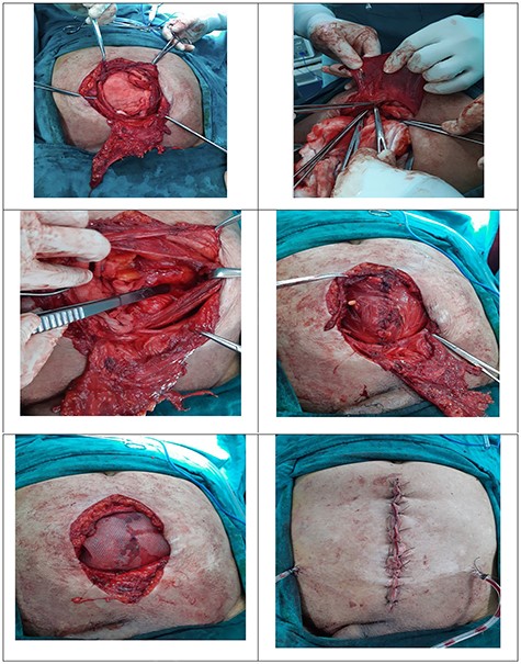 Incisional hernia with large sac; excision posterior rectus sheath; TAR; line of insertion of transversus abdominis; abdominal wound after skin approximation.